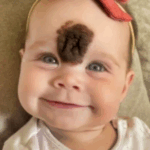 ¡Padres Remueven la Rara Marca de Nacimiento de su Bebé para Protegerla de la Crueldad! ¡Mira Cómo Luce Hoy!