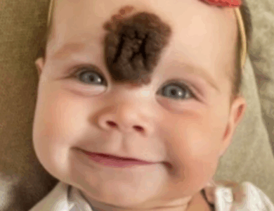 ¡Padres Remueven la Rara Marca de Nacimiento de su Bebé para Protegerla de la Crueldad! ¡Mira Cómo Luce Hoy!