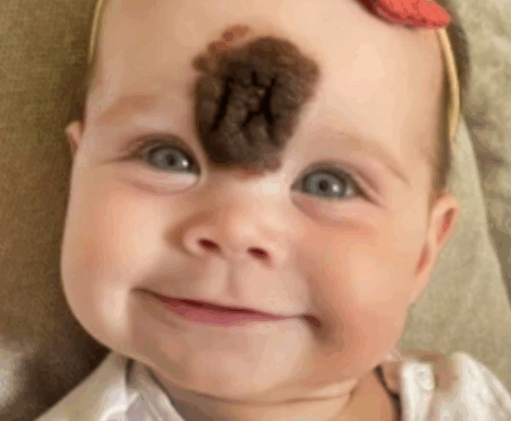 ¡Padres Remueven la Rara Marca de Nacimiento de su Bebé para Protegerla de la Crueldad! ¡Mira Cómo Luce Hoy!