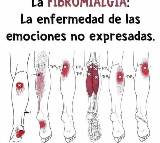 ¿Te duelen los músculos sin razón aparente? Podría ser fibromialgia