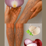 Remedios Caseros para las Várices con Cebolla, Ajo y Vinagre de Manzana