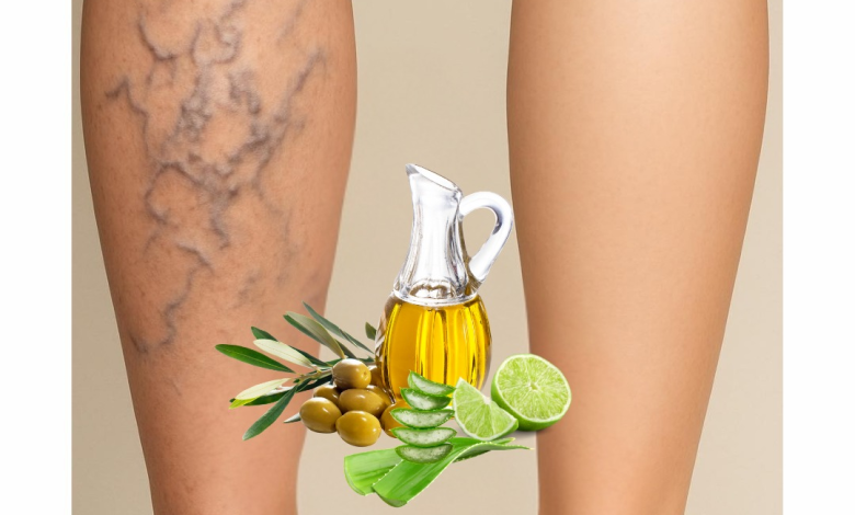 Remedio Natural para las Várices con Sábila, Vinagre y Limón