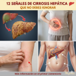 12 señales de cirrosis hepática que no debes ignorar 12 señales de cirrosis hepática que no debes ignorar