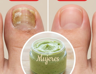 Remedios Naturales para los Hongos en los Pies y en las Uñas